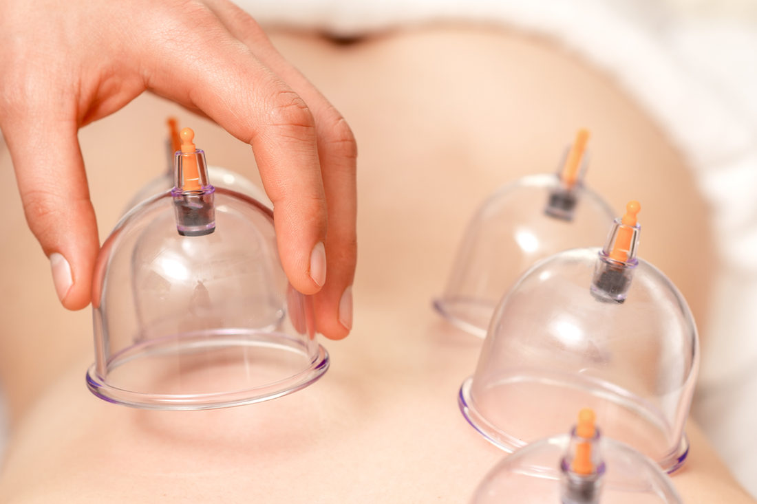 Cupping therapy